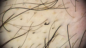 Tricoscopia de placa de alopecia por tricotilomanía. Se observan puntos negros y en el centro de la imagen un coiled hair generado por la tracción sobre el tallo.