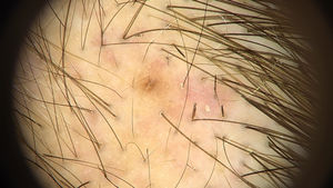 Tricoscopia de placa de alopecia con tricotilomanía con pelos en signo de exclamación y tricoptilosis (broom hairs).