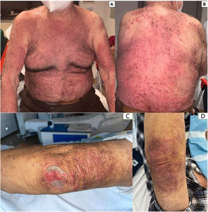 Case #1. Inflammatory violaceous plaques on the trunk with erosions and ulcerations (A, B); Case #2. Purplish discoloration and ulceration on psoriatic plaques located on both elbows (C, D).