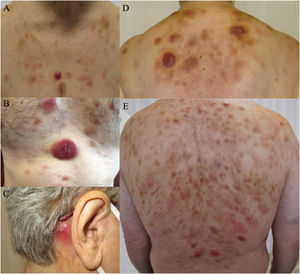 Clinical spectrum of skin lesions of blastic plasmacytoid dendritic cell neoplasm. (a, b, d) Multiple erythematous nodules with bruise-like plaques on the chest and upper back. (c) Isolated erythematous nodular lesion on the retroauricular area. (e) Diffuse bruise-like plaques on the back with presence of scattered nodular violaceous lesions.