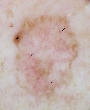 Imagen dermatoscópica. Centro desestructurado eritematoso con una vascularización atípica (flechas negras), un foco de pigmentación excéntrica (triángulo negro) y un retículo típico en la periferia (flecha blanca).