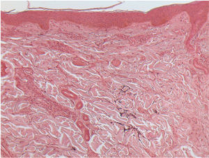 Pérdida casi total de las fibras elásticas de la dermis papilar y reticular (tinción de orceína, 100×).