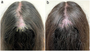 (a) Placa de alopecia cicatricial extensa en el vértex y la coronilla, que se extiende a las regiones parietales izquierda y derecha del cuero cabelludo; eritema intenso, escamas adherentes, costras amarillentas/hemorrágicas, pústulas e hipertricosis. (b) Mejoría satisfactoria tras el abordaje terapéutico: reducción del eritema, pústulas y descamación, crecimiento del cabello sin progresión de la alopecia.