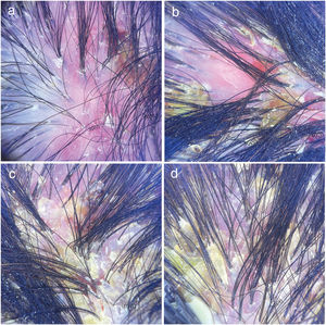 Tricoscopia: (a) Eritema intenso, menor densidad de folículos pilosos, descamación blanca perifolicular e interfolicular, penachos foliculares, costras hemorrágicas, zonas de color rojo lechoso, vasos sanguíneos dilatados. (b) Eritema intenso, menor densidad de folículos pilosos, descamación blanca perifolicular, penachos foliculares, costras amarillentas/hemorrágicas, zonas de color rojo lechoso. (c) Penachos foliculares, escamas adherentes, costras amarillentas/hemorrágicas. (d) Descamación blanca perifolicular, penachos foliculares, costras amarillentas y adherentes.