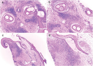 Estudio histopatológico: (a, b) Corte vertical revelando ausencia de glándulas sebáceas, infiltrados linfoplasmocitarios intersticiales, escasos neutrófilos, agregados de células plasmáticas, fibrosis concéntrica perifolicular y granulomas alrededor de los tallos pilosos fragmentados (tinción de hematoxilina-eosina; ×100). (c) Corte horizontal que muestra hiperqueratosis, infiltrados linfoplasmocitarios perifoliculares e intersticiales, escasos neutrófilos y un granuloma alrededor del folículo piloso (tinción de hematoxilina-eosina; ×40). (d) Corte horizontal donde se aprecian infiltrados linfoplasmocitarios perifoliculares e intersticiales, escasos neutrófilos y granuloma alrededor de folículo piloso (tinción de hematoxilina-eosina, ×100).