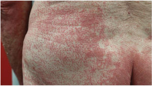 Islotes de piel no afectados en un paciente con PRP.