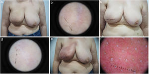 Imágenes clínicas y dermatoscópicas de una paciente con cáncer de mama en radioterapia con RA de grado 2 antes (a, b), al final (c, d) y a los 3 meses (e, f) de la radioterapia.