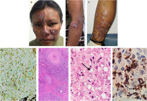 Brownish erythematous plaques on the face (A). Violaceous plaques on left forearm and arm (B). Nodules and a large erythematous infiltrated plaque on the posterior lower left leg with areas of ulceration (C). Positive Gomori structures within histiocytes (Gomori staining, 40×). (D) Granulomatous nodular inflammatory process consisting of lymphocytes, histiocytes, and some plasma cells in the upper and deep dermis (H&E staining, 10×). (E) Leishmania amastigote, arrow (H&E staining, 600×). (F) Anti-CD68 (clone KP1) immunohistochemistry showing intense cytoplasmic positivity in macrophages. In addition, some amastigotes can be observed, arrows (IHQ, 600×) (G).