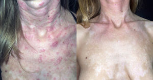 Lupus eritematoso cutáneo subagudo refractario. A) Mujer con múltiples placas eritematosas en cuello y escote, refractarias a corticoides tópicos, prednisona, hidroxicloroquina, mepacrina, metotrexato, belimumab y rituximab. B) Respuesta completa tras inicio de anifrolumab 300mg cada cuatro semanas.