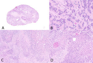 Hematoxylin-eosin. A) Macromicro photo. B) Mesenchymal component of osteosarcoma. C) Transitional regions between osteoid and squamous components. D) Epithelial component of squamous cell carcinoma.
