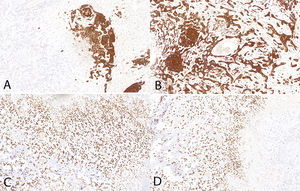 Immunohistochemistry. A) CK AE1/AE3: positive in squamous areas, negative in osteoid areas. B) CK AE1/AE3: positive in the squamous area. C) SATB2: positive in osteoid areas. D) SATB2: positive in the osteoid area, negative in the squamous component.