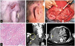 Images from patient #1. A and B) Clinical appearance of SCC affecting the upper and middle thirds of the right pinna. C) Functional neck dissection. The image shows the external jugular vein, the parotid gland, and the facial nerve. D) Hematoxylin and eosin stain, 200x. Moderately differentiated keratinizing tumor forming keratin pearls. E) Coronal image, contrast-enhanced computed tomography (CT) showing right supraclavicular lymphadenopathy (circle); asterisk indicates pleural effusion. F) Cross-sectional image, contrast-enhanced CT, asterisk indicates pleural effusion.