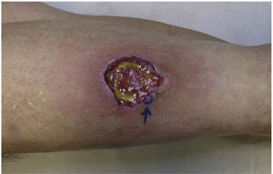 Ulcer with poorly defined, violaceous edges and a fibrinoid base on the leg anterior region.