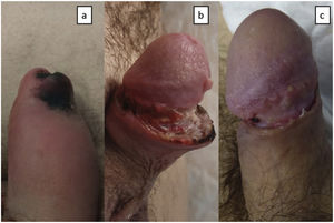 a) Necrotic plaque on the foreskin and edematous penile shaft. b) Penile shaft with surgical wound dehiscence and increased necrosis. c) Penile shaft with reduced edema, and resolution of both dehiscence and necrosis.