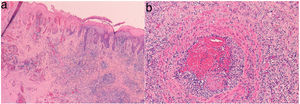a) Hematoxylin-eosin x10. Epidermal necrosis and dense chronic inflammation. b) Hematoxylin-eosin x20. Vasculitis with thrombosis.