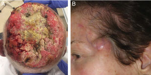a) 98-year-old male with a large cutaneous squamous cell carcinoma, affecting the entire scalp with bone invasion involving the entire cranial vault. b) Woman with cutaneous squamous cell carcinoma operated on the left forehead (see the scar) who developed satellite lesions in the form of a dermal tumor nodule on the left temple a few weeks after surgery.