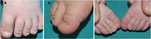 A) Nails of a newborn with triangular morphology, Beau's lines, and koilonychia. B) Koilonychia with everted nail edges and a central concavity. C) Hypertrophy of the lateral fold of the first toes of a neonate covering part of the nail plate.