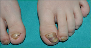 Bilateral congenital misalignment of the first toe with greater involvement on the left side. Dystrophic nail with lateralized growth, trapezoidal morphology, Beau's lines, onycholysis, and yellowish-brown coloration.