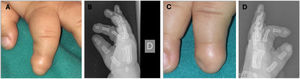 Iso-Kikuchi Syndrome. A and C) Anonychia of the second finger of the right hand and minimal nail bud on the left hand. B and D) Simple X-ray showing a “Y” shaped notch at the level of the distal phalanx of both fingers.