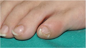 Congenital double nail of the fifth toe. A wider nail with a longitudinal split separating the nail in 2 parts, the smaller part being the accessory nail.