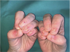 Fong disease or nail-patella syndrome. Nail hypoplasia of the first, second, fourth, and fifth fingers of both hands with typical triangular lunulae on the third fingers. Additionally, the nail plate of the second, fourth, and fifth fingers of both hands does not reach the free edge of the finger.