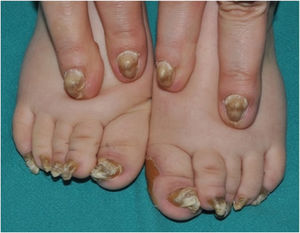 Congenital pachyonychia in a mother and her child. The toenails show a significant increase in the thickness of the nail plate and nail bed taking on the shape of a hook, along with a white-yellow coloration. Plantar keratoderma can also be seen on the inner edge of the first toe of the left foot. In the fingernails, pachyonychia can also be seen, along with a yellowish-brown coloration.