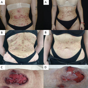 Pyoderma gangrenosum treated with upadacitinib: (a) case #2 prior to upadacitinib therapy; (b) case #2, 10 weeks after starting upadacitinib; (c) case #3 prior to upadacitinib; (d) case #3, 4 weeks after starting upadacitinib.