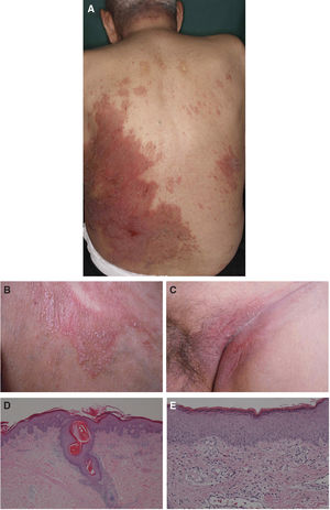 (A) Clinical picture of brownish red plaques on the back. (B) High-power view of follicular keratotic papules on the patient