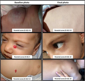 Images have been chosen to represent the patients’ mean value in each group: the first pair represents those on propranolol, the second those on timolol and the third pair, observation.