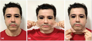 Evaluación facial del paciente en posición de reposo (a), extensibilidad de la piel lateral (b) y anterior (c) que refleja hipermovilidad y laxitud intensa de la piel.