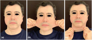 Evaluación facial del paciente transcurridos 180 días del primer protocolo de tratamiento – dos sesiones de tratamiento de cara completa con intervalo mensual en 2019. Posición de reposo (a), extensibilidad de la piel lateral (b) y anterior (c) que refleja estímulo significativo de colágeno con mejora del contorneo y estiramiento de la piel.