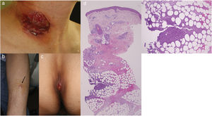 (a) Úlcera profunda bien demarcada en el sitio de inserción del catéter venoso central. (b) Nódulos eritematosos dolorosos en el antebrazo (flecha). (c) Lesión ulcerativa en la zona sacra. (d) Examen histopatológico que refleja paniculitis lobular (H-E, ×20). (e) Mayor amplificación que muestra infiltración neutrofílica en el tejido graso (H-E, ×200).