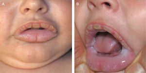 Hyperkeratotic white-yellowish plaques affecting the entire external labial mucosa (A). Bilateral and symmetrical whitish velvety plaques on the buccal, internal labial, and lateral lingual mucosae (B).