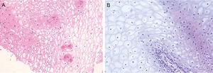 Biopsy of the buccal mucosa showing mainly acanthosis, intracellular edema in keratinocytes, and dyskeratosis (HE).