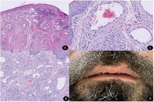 Intradermal proliferation of lobulated vascular structures with prominent endothelium and inflammatory infiltrate (panoramic Hematoxylin & Eosin) (A). Prominent endothelial cells with abundant eosinophilic cytoplasm (H&E x10) (B). Prominent endothelial cells with abundant eosinophilic cytoplasm mainly surrounded by lymphocytes and a few isolated eosinophils (H&E x20) (C). Complete resolution of erythematous nodules after laser treatment.