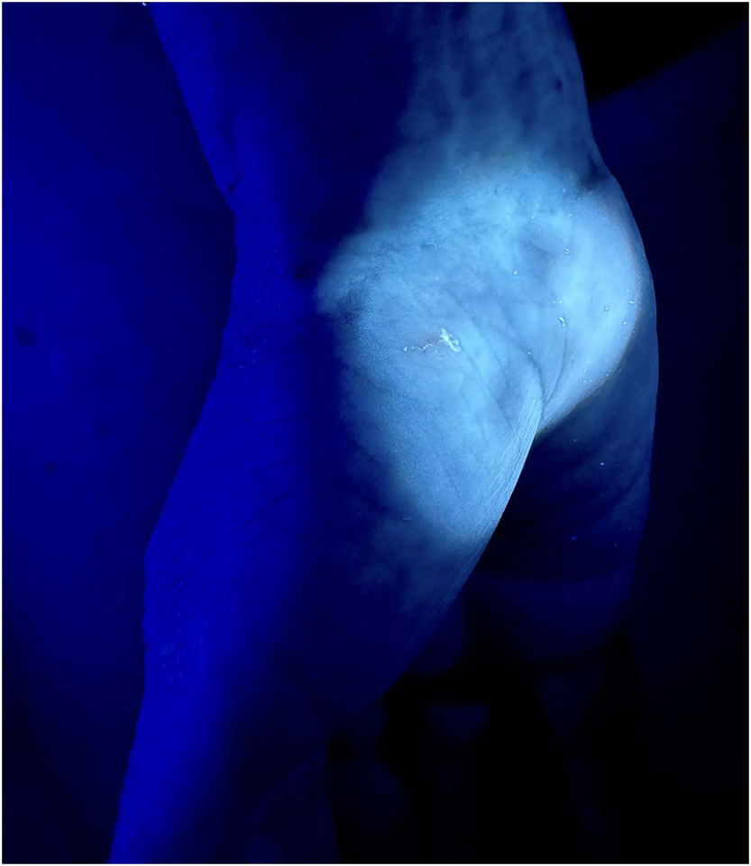 Use of 365nm LED Ultraviolet Light in the Diagnosis of Scabies Actas