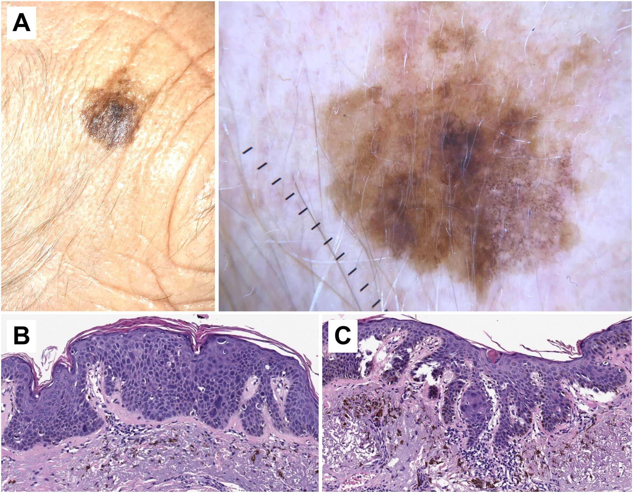 Dermoscopy Of Squamous Cell Carcinoma From Actinic Keratosis To Dermoscopy Of Squamous Cell Carcinoma From Actinic Keratosis To
