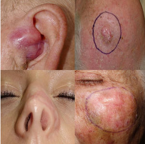 Images of different forms of desmoplastic melanomas from our series showing clinical differences vs non-desmoplastic melanomas.