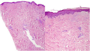 A and B. H-E (2×, 20×). Localized plaque morphea. Skin biopsy with marked loss of skin appendages and presence of abundant bands of fibrosis occupying the mid and deep dermis. B. Detail of thickened collagen bands, findings suggestive of localized plaque morphea.