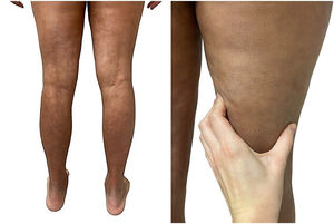 A and B. Clinical appearance of the patient. A. Orange peel skin and rope sign in both popliteal fossae. B. Difficulty pinching the skin due to marked hardening.