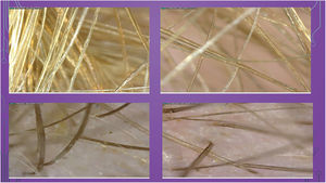 Trichoscopy showing grooved hairs emerging in different directions and crossing each other.