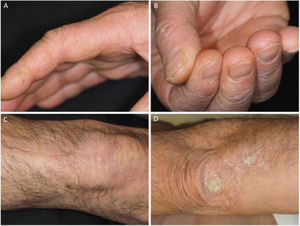 Hyperkeratotic, scaling, and fissured plaques on the radial side of the second finger (A), finger pads (B), knees (C), and elbows (D).