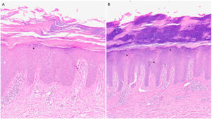 Biopsy of elbows (A) and hands (B). H-E staining. Checkerboard hyperkeratosis, alternating areas of orthokeratosis with parakeratosis, and apoptotic keratinocytes in the form of colloid bodies (*) in the epidermis.