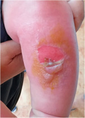 Erythematous-edematous plaque with denuded areas and blisters in the pretibial area.