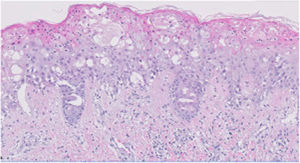 Dermal-epidermal junction with vacuolization changes. Presence of edema and sparse perivascular lymphocytic infiltrate on superficial dermis.