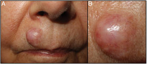 Clinical image of the lesion. A) Nodule located on the right upper lip, with preservation of the follicles in that area. B) Detail of the lesion.