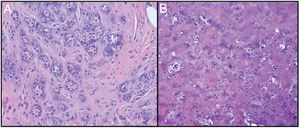 Histopathological images of the lesion. A) Epithelial component formed by ducts covered by a single layer of cuboidal epithelium (H&E,×20). B) Myxoid stromal component with areas of chondroid predominance (H&E,×20).