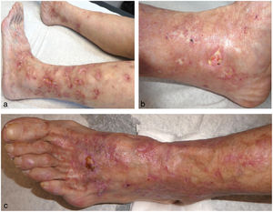 Livedoid vasculopathy lesions affecting the lower limbs. Livedoid changes, atrophie blanche, and fibrinoid ulcers can be observed.