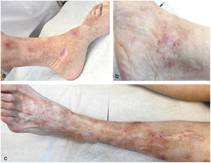 Livedoid vasculopathy lesions 1 month after spinal cord posterior column stimulation implant. Ulcer healing and improvement of livedoid changes are observed. Additionally, pain control was achieved.