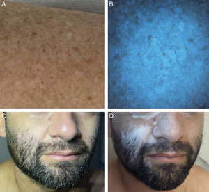 A) Poroqueratosis actínica diseminada B) Luz de Wood. «Collar de diamantes»: fluorescencia blanca de la escama hiperqueratósica. C) Vitíligo facial incipiente. D) Se observa un notorio aumento de la visibilidad de las áreas hipopigmentadas con luz de Wood.